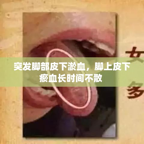 突發(fā)腳部皮下淤血，腳上皮下瘀血長(zhǎng)時(shí)間不散 