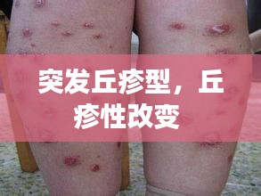 突發(fā)丘疹型，丘疹性改變 